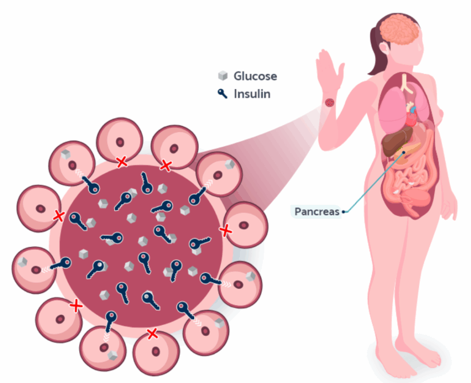 Prevencija insulinske rezistencije kroz ishranu i kretanje